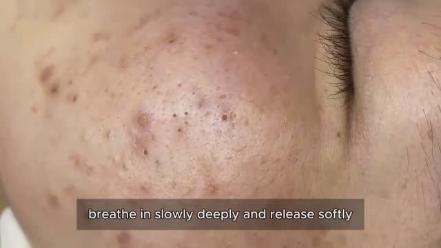 Салонная чистка лица от черных и белых комедонов 90331 смотреть онлайн