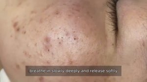 Салонная чистка лица от черных и белых комедонов 90331