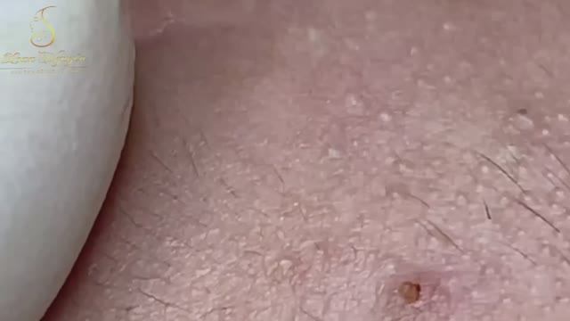 ХВАТИТ МУЧИТЬ КОЖУ! Ваше лечение акне может быть опасным