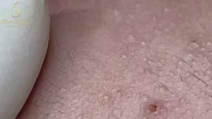 ХВАТИТ МУЧИТЬ КОЖУ! Ваше лечение акне может быть опасным