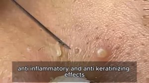 Лечим прыщи на лице: комплексный подход 90334