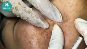 Полное избавление от черных точек на носу и щеках HANA #12