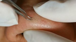 Чистка лица от угрей и акне. Выдавливание прыщей. Удаление черных точек и комедонов