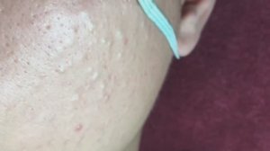 Белые угри у 16-летнего парня / Профессиональная чистка