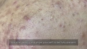 Профессиональное удаление черных точек и сальных пробок. 90322