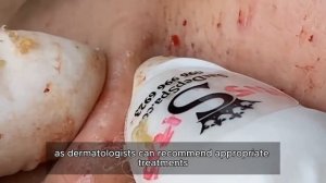 Asmr. Выдавливание прыщей и удаление сальных пробок. 90304