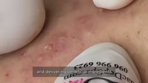 Избавляемся от открытых комедонов. Глубокая процедура. #𝟗𝟎419