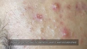 Удаление открытых комедонов у косметолога #𝟗𝟎369