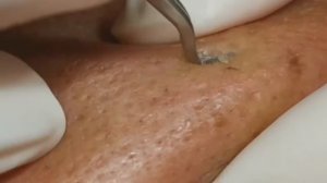 Чистка лица от угрей и акне. Выдавливание прыщей. Удаление черных точек и комедонов