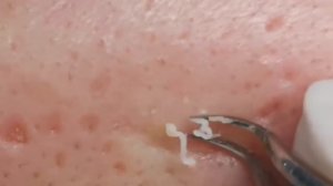 Чистка лица от угрей и акне. Выдавливание прыщей. Удаление черных точек и комедонов