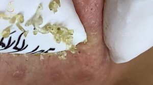 Asmr. Убирание черных точек с лица.