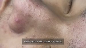 Безопасное профессиональное удаление комедонов 90318