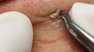 Чистка лица от угрей и акне. Выдавливание прыщей. Удаление черных точек и комедонов