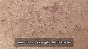 Избавляемся от комедонов. Механический метод 90395