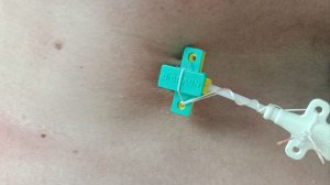 Фиксация ЦВК