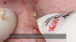 Лечение прыщей на лице. Глубокая процедура. 90303