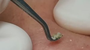 Чистка лица от угрей и акне. Выдавливание прыщей. Удаление черных точек и комедонов