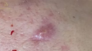 Профессионально чистим кожу от прыщей