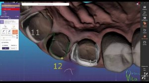 #exocad #виниры #стоматология #stomatology #3d #dentistry
