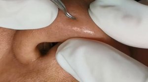 Чистка лица от угрей и акне. Выдавливание прыщей. Удаление черных точек и комедонов