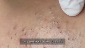 Asmr. Очищение лица от черных точек 90352