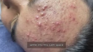 Избавление от угрей и сальных пробок. 𝟗𝟎419