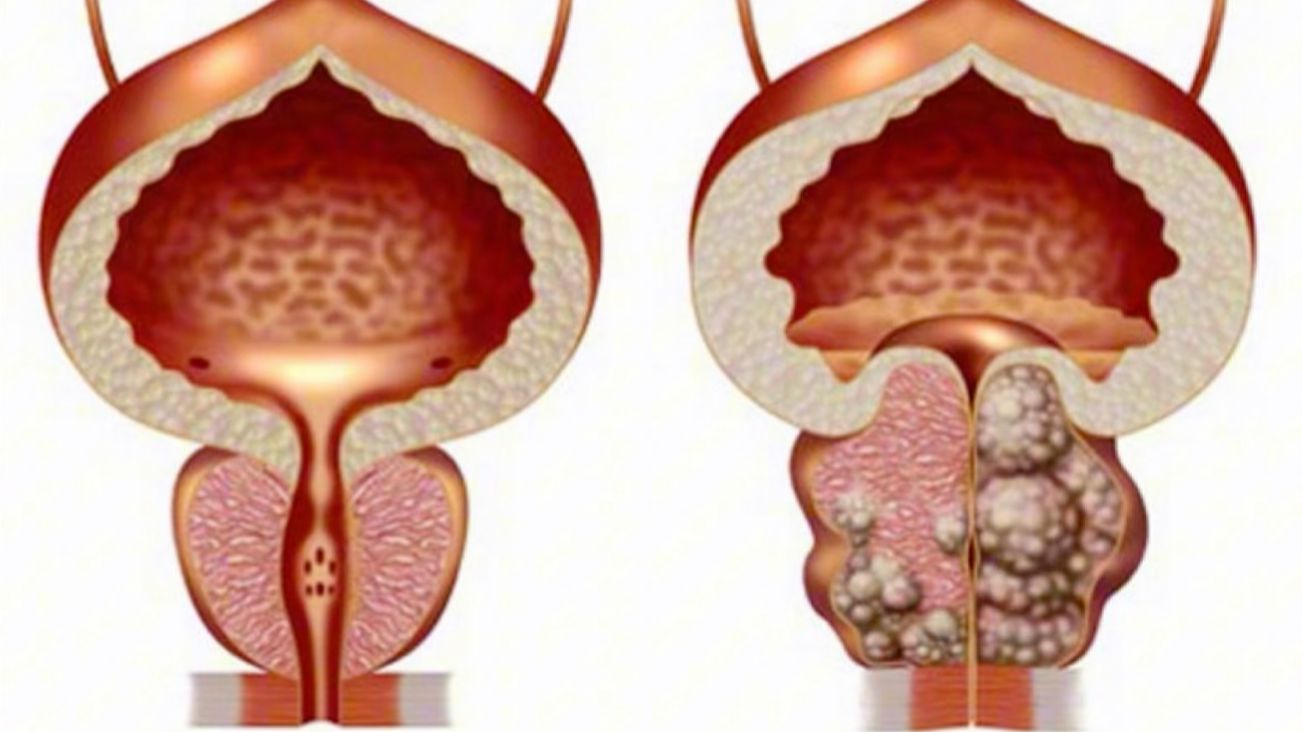 Аппарат Импловит «Катушка Мишина». «Мужская сила». Простатит и аденома простаты