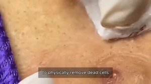 Asmr. Выдавливание черных точек #𝟗𝟎433