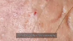 Asmr. Удаление угревой сыпи. #𝟗𝟎436