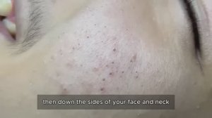 Очищение кожи от комедонов. Механическая чистка 90411