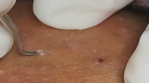 Чистка лица от угрей и акне. Выдавливание прыщей. Удаление черных точек и комедонов