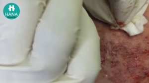 Asmr. Избавляемся от угревой сыпи. HANA #03