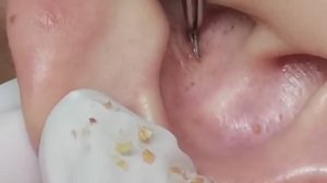 Чистка лица от угрей и акне. Выдавливание прыщей. Удаление черных точек и комедонов