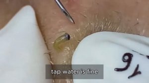 Полное избавление от закрытых комедонов #𝟗𝟎435