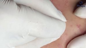 Удаление скрытых прыщей. Часть 2 GA