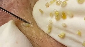 Выдавливание прыщей, угрей, черных точек и камедонов #224