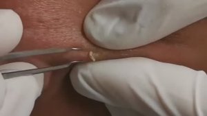 Чистка лица от угрей и акне. Выдавливание прыщей. Удаление черных точек и комедонов