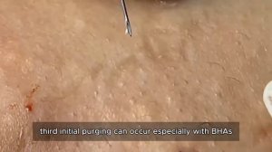 Очищение лица от акне. Расслаблющее видео. #𝟗𝟎445