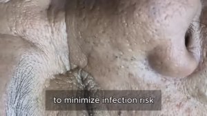 Asmr. Механическое очищение от угревой сыпи. #𝟗𝟎447