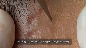 Глубокое очищение пор от открытых комедонов #𝟗𝟎450