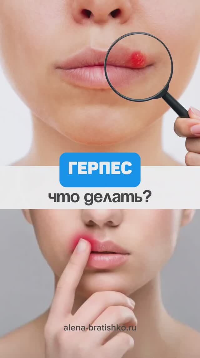 Герпес: что делать? Семейный доктор Алена Братишко