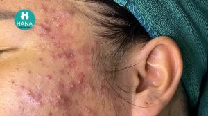 Asmr. Механическая чистка от угревой сыпи HANA #65