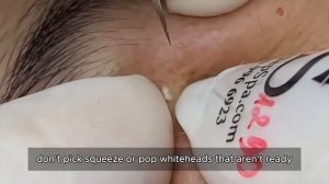 Asmr. Очищение лица от угревой сыпи. #𝟗𝟎441