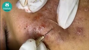 Asmr. Профессиональное удаление от угрей. HANA #24