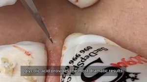 Asmr. Лечение черных точек. #𝟗𝟎420