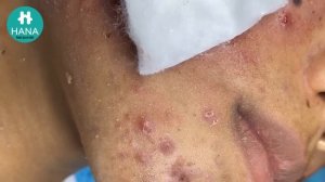 Asmr. Чистим лицо от угревой сыпи. HANA #15