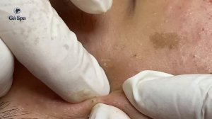 Чистка всего лица от прыщей GA