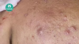 Чистка лица от закрытых комедонов на скулах и подбородке HANA #73