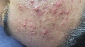 Механическая чистка от открытых комедонов и черных точек #𝟗𝟎440