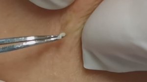 Чистка лица от угрей и акне. Выдавливание прыщей. Удаление черных точек и комедонов